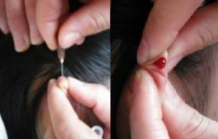 Kỹ thuật Chích lể chỉ theo y học cổ truyền